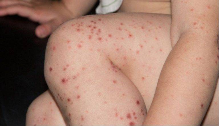 BC en vigilancia epidemiológica por brote de Sarampión